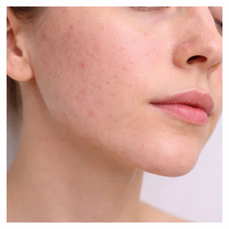 Imperfections et peau à tendance acnéique